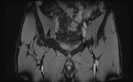 Anterior inferior iliac spine avulsion fracture (Radiopaedia 81312-95000 G 73).jpg