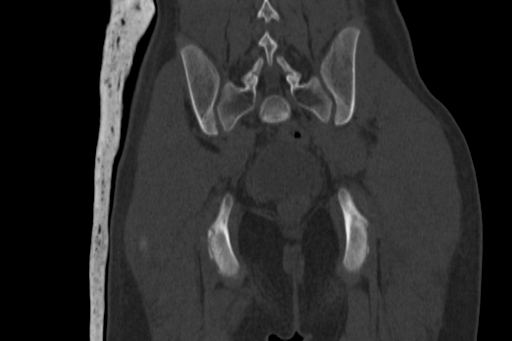 Anterior inferior iliac spine avulsion injury (Radiopaedia 88666-105376 Coronal bone window 54).jpg