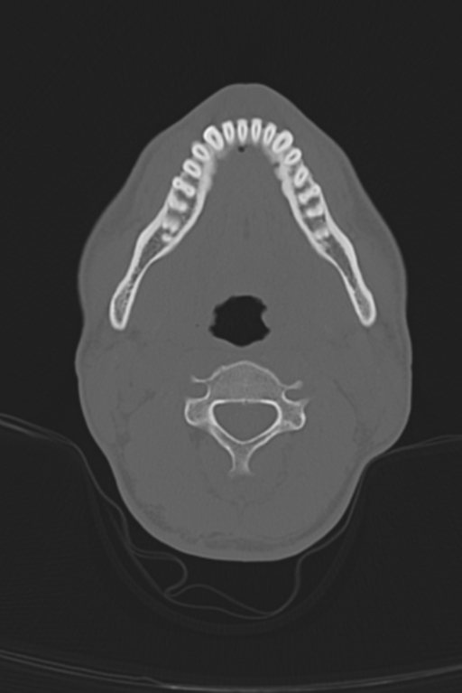 Anterior nasal spine fracture (Radiopaedia 46138-50494 Axial bone window 69).png