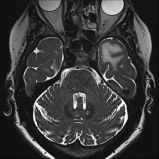 Anterior temporal pole cysts (Radiopaedia 46629-51102 Axial T2 48).png