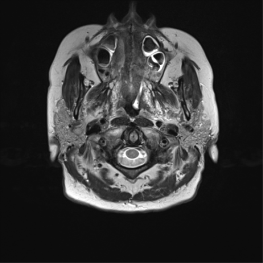 File:Anterior temporal pole cysts (Radiopaedia 46629-51102 C 1).png