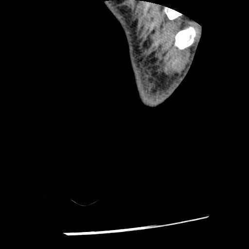 File:Anterior tibial artery false aneurysm (Radiopaedia 88984-105809 A 270).jpg