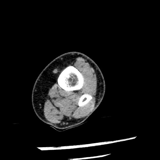 Anterior tibial artery false aneurysm (Radiopaedia 88984-105809 A 39).jpg