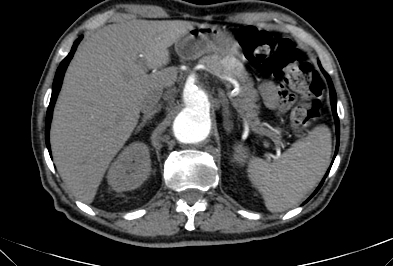 File:Anterior vertebral scalloping (abdominal aortic aneurysm) (Radiopaedia 66744-76067 F 9).jpg