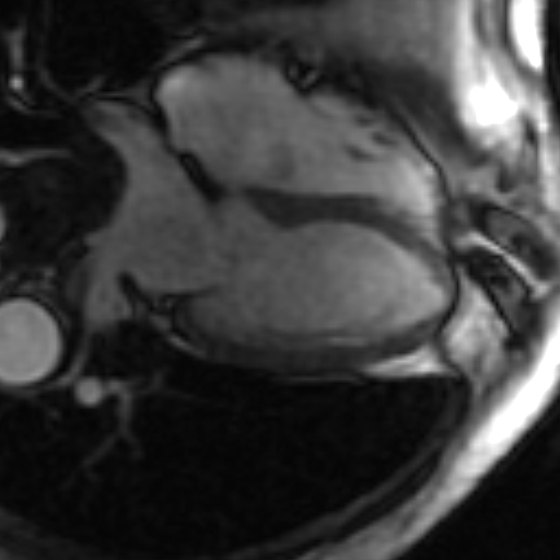 File:Anteroseptal hypokinesia after myocardial infarction (Radiopaedia 15978-15633 4 chamber view SSFE 21).jpg