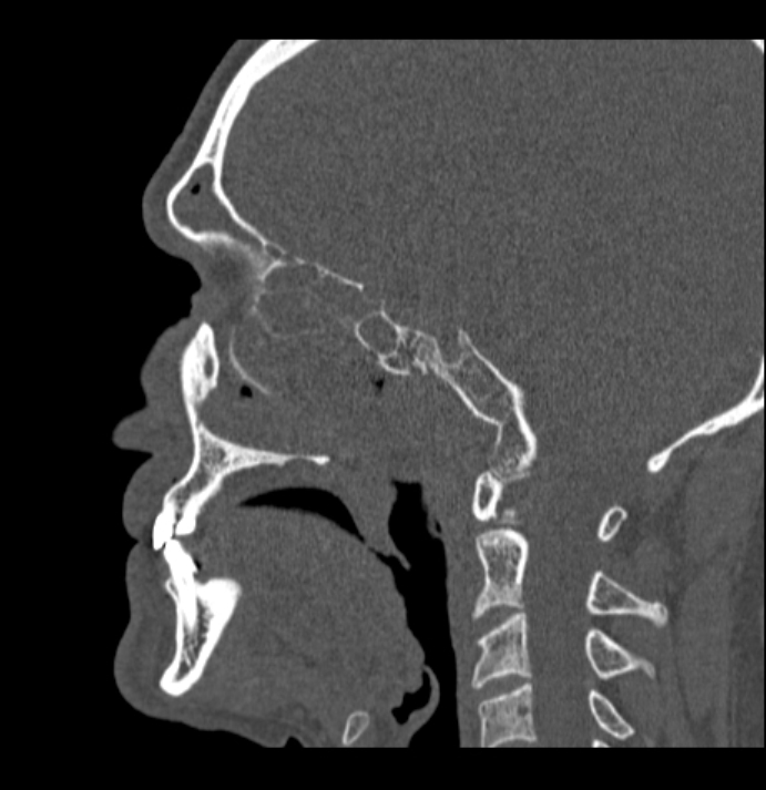Antrochoanal polyp (Radiopaedia 79011-92169 Sagittal bone window 18).jpg