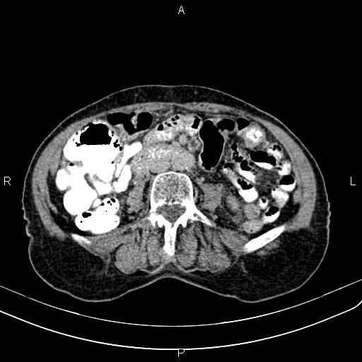 Aortic aneurysm and Lemmel syndrome (Radiopaedia 86499-102554 Axial C+ delayed 43).jpg