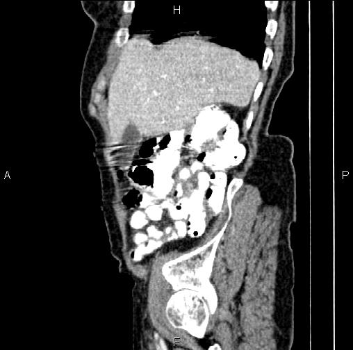 Aortic aneurysm and Lemmel syndrome (Radiopaedia 86499-102554 D 15).jpg