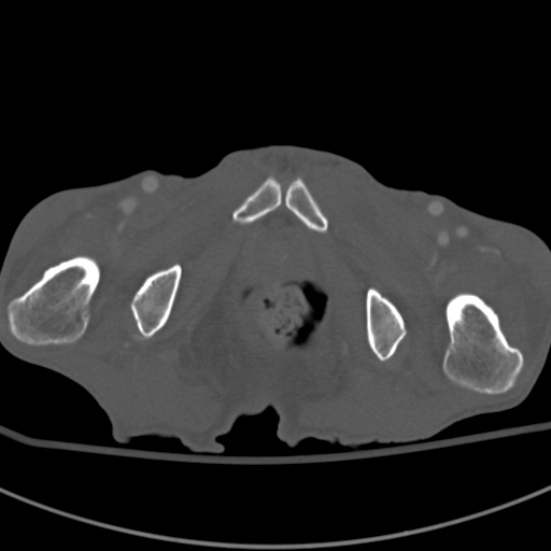 Aortic aneurysm with spinal destruction (Radiopaedia 42301-45410 Axial bone window 119).jpg