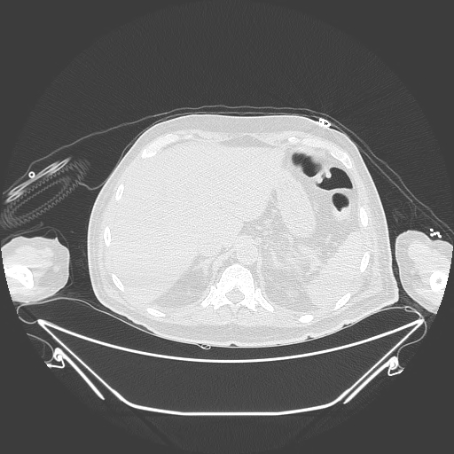 Aortic arch aneurysm (Radiopaedia 84109-99365 Axial lung window 259).jpg