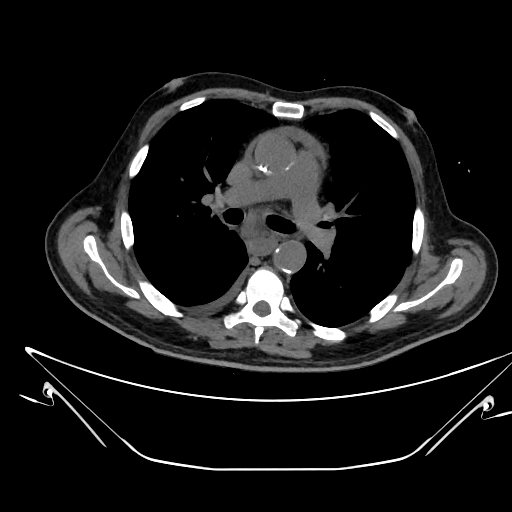 Aortic arch aneurysm (Radiopaedia 84109-99365 Axial non-contrast 124).jpg