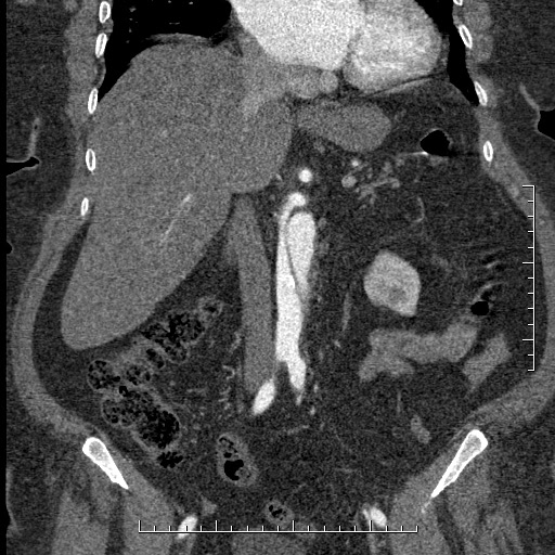 Aortic dissection- Stanford A (Radiopaedia 35729-37268 F 35).jpg