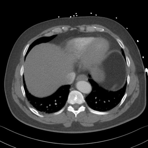File:Aortic dissection (Radiopaedia 50763-56234 A 58).png