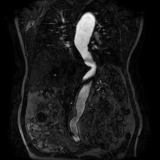 Aortic dissection - Stanford A - DeBakey I (Radiopaedia 23469-23551 D 135).jpg