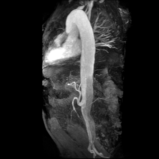 File:Aortic dissection - Stanford A - DeBakey I (Radiopaedia 23469-23551 MRA 17).jpg