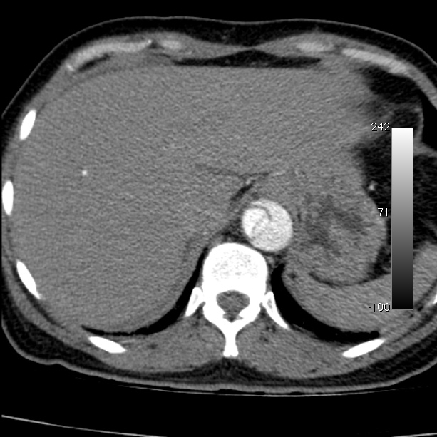 Aortic dissection - Stanford type A (Radiopaedia 29247-29659 A 68).jpg