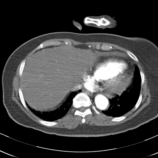 File:Aortic dissection - Stanford type A (Radiopaedia 39073-41259 A 62).png