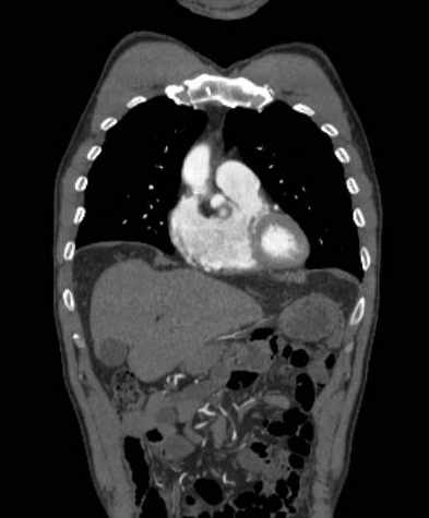 File:Aortic dissection - Stanford type B (Radiopaedia 73648-84437 B 34).jpg