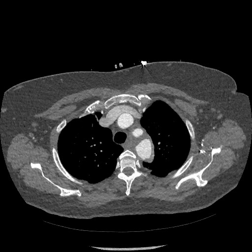 Aortic dissection - Stanford type B (Radiopaedia 88281-104910 A 13).jpg