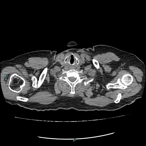 File:Aortic dissection extended to lusory artery (Radiopaedia 43686-47136 Axial non-contrast 1).jpg
