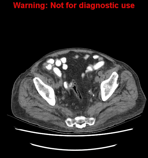 File:Aortic graft infection (Radiopaedia 44979-48907 Axial non-contrast 80).jpg
