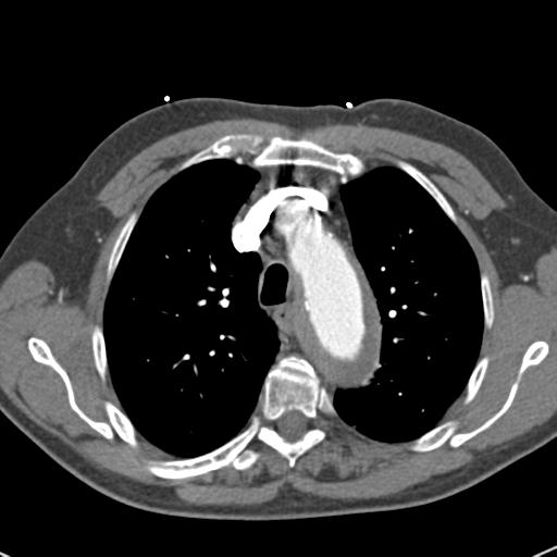 Aortic intramural hematoma (Radiopaedia 31139-31838 B 27).jpg