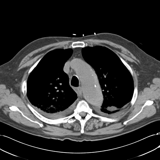 Aortic intramural hematoma (Radiopaedia 34260-35540 Axial non-contrast 19).png