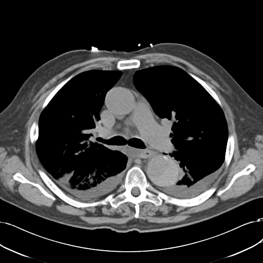Aortic intramural hematoma (Radiopaedia 34260-35540 Axial non-contrast 26).png
