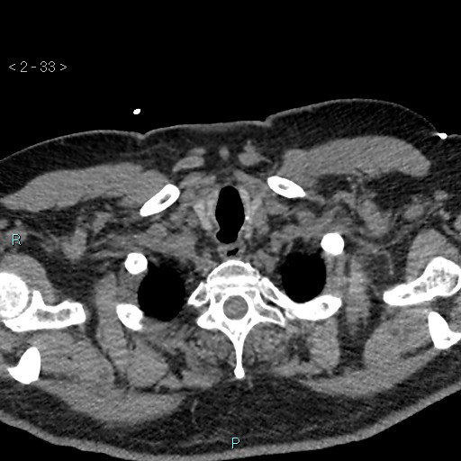 File:Aortic intramural hematoma (Radiopaedia 48463-53380 Axial non-contrast 15).jpg