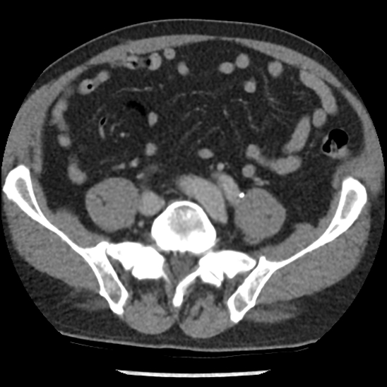 File:Aortic intramural hematoma (type B) (Radiopaedia 79323-92387 Axial C+ delayed 89).jpg