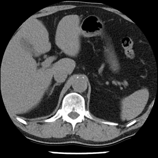 Aortic intramural hematoma (type B) (Radiopaedia 79323-92387 Axial non-contrast 55).jpg