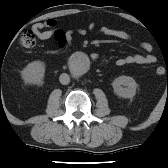 File:Aortic intramural hematoma (type B) (Radiopaedia 79323-92387 Axial non-contrast 74).jpg