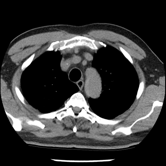 Aortic intramural hematoma (type B) (Radiopaedia 79323-92387 Axial non-contrast 9).jpg