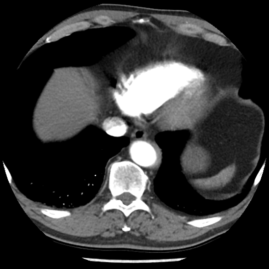 File:Aortic intramural hematoma (type B) (Radiopaedia 79323-92387 B 44).jpg