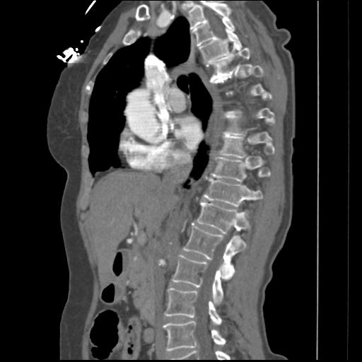 File:Aortic intramural hematoma from penetrating atherosclerotic ulcer (Radiopaedia 31137-31836 B 25).jpg