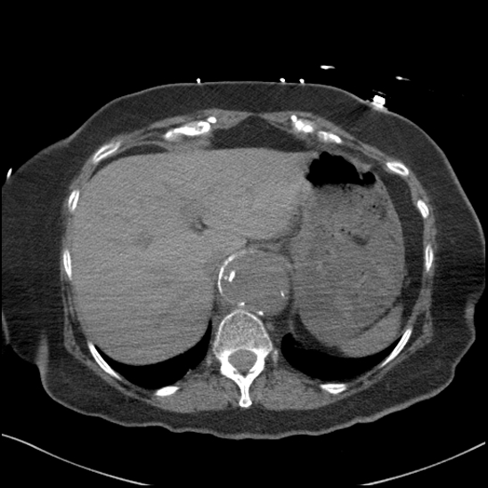 Aortic intramural hematoma with dissection and intramural blood pool (Radiopaedia 77373-89491 Axial non-contrast 88).jpg
