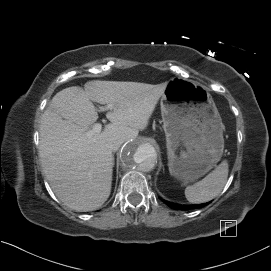 File:Aortic intramural hematoma with dissection and intramural blood pool (Radiopaedia 77373-89491 E 4).jpg