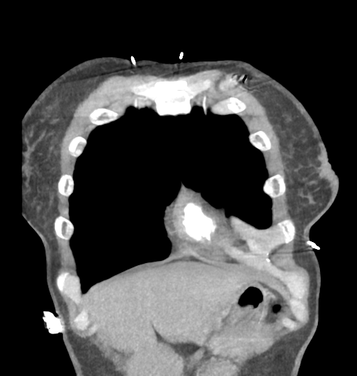 File:Aortic valve non-coronary cusp thrombus (Radiopaedia 55661-62189 C 14).png