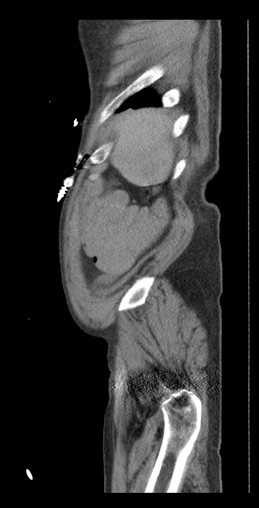 Aortoduodenal fistula (Radiopaedia 75286-86415 Sagittal C+ delayed 60).jpg