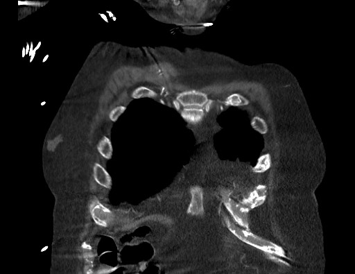 Aortoesophageal fistula with endovascular repair (Radiopaedia 73781-84592 Coronal C+ CTPA 7).jpg