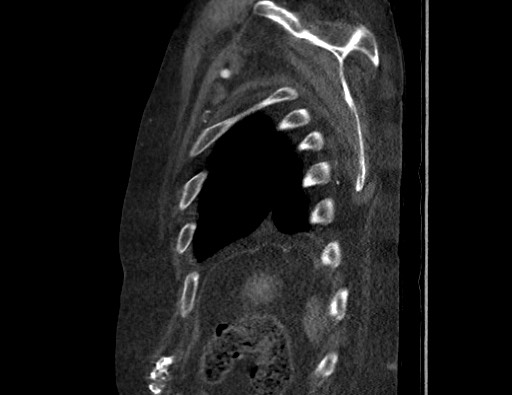 File:Aortoesophageal fistula with endovascular repair (Radiopaedia 73781-84592 Sagittal C+ CTPA 178).jpg