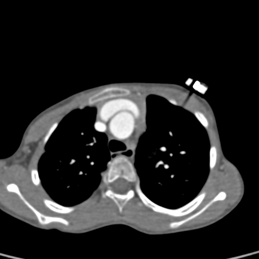 File:Aortopulmonary window, interrupted aortic arch and large PDA giving the descending aorta (Radiopaedia 35573-37074 B 24).jpg