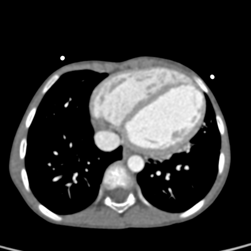 File:Aortopulmonary window, interrupted aortic arch and large PDA giving the descending aorta (Radiopaedia 35573-37074 B 66).jpg