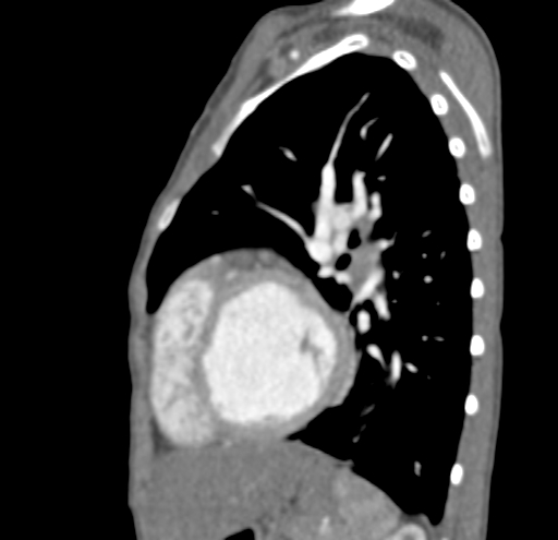 File:Aortopulmonary window, interrupted aortic arch and large PDA giving the descending aorta (Radiopaedia 35573-37074 C 38).jpg