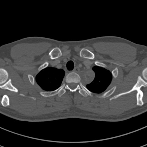 Apical lung mass mimic - neurogenic tumor (Radiopaedia 59918-67521 Axial bone window 10).jpg