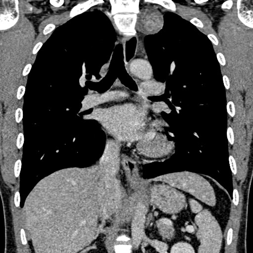 Apical lung mass mimic - neurogenic tumor (Radiopaedia 59918-67521 B 66).jpg