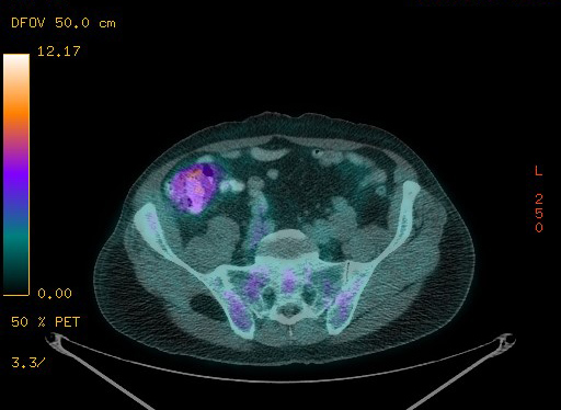 Appendiceal adenocarcinoma complicated by retroperitoneal abscess (Radiopaedia 58007-65041 Axial PET-CT 161).jpg