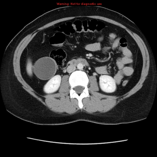 Appendiceal mucinous cystadenoma (Radiopaedia 8263-9111 Axial liver window 40).jpg