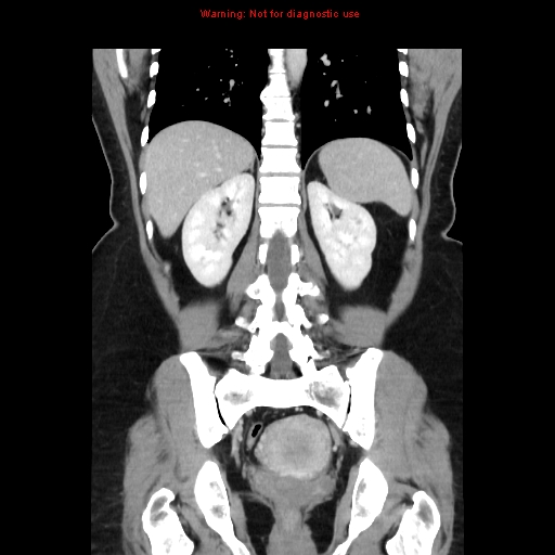 File:Appendiceal mucinous cystadenoma (Radiopaedia 8263-9111 B 52).jpg