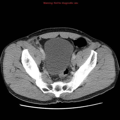 Appendicitis and renal cell carcinoma (Radiopaedia 17063-16760 A 48).jpg